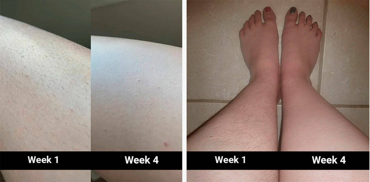 5minSkin Laser Hair Removal Review - Scam or Legit Pain-Free At-Home  Handset Worth It?