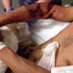 An image of Urbano Velazquezs arm after he was bitten by a King County Sheriffs Office K-9. It has been cropped to remove Velazquezs face. Photo obtained through a records request from King County Sheriffs Office.